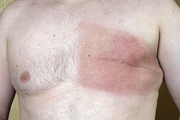 Hình ảnh ung thư vú ở nam giới đã được điều trị cắt bỏ vú