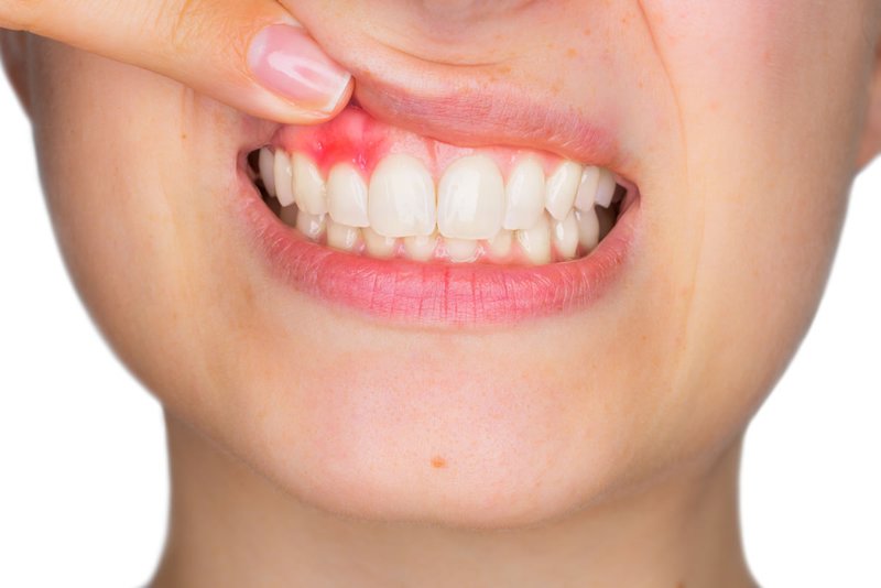 Viêm lợi chân răng kèm sâu răng điều trị thế nào?