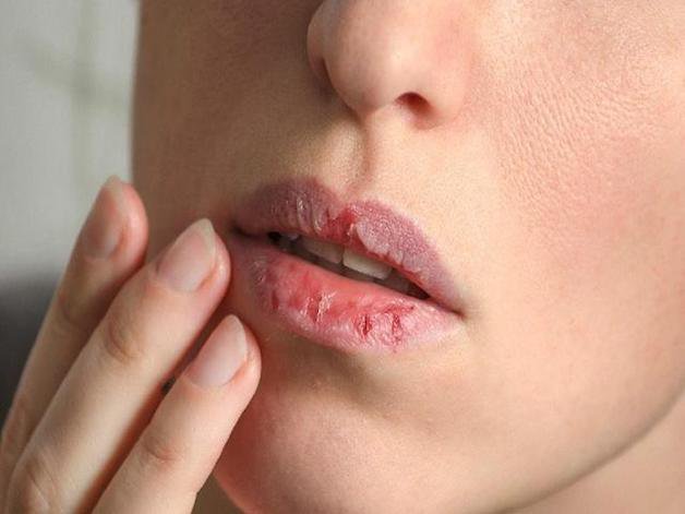 Khô miệng là một trong các triệu chứng thiếu sắt dễ dàng nhận biết