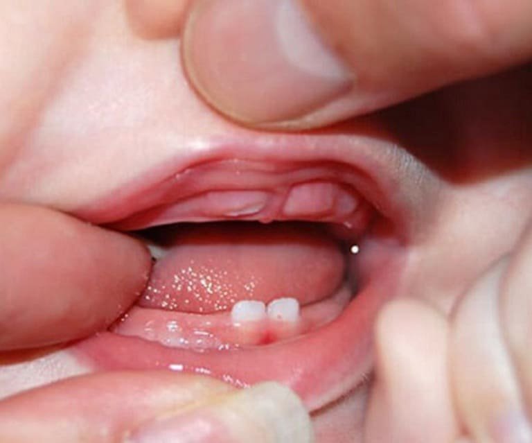 Trẻ mọc răng kèm nướu sưng chảy máu phải làm sao?