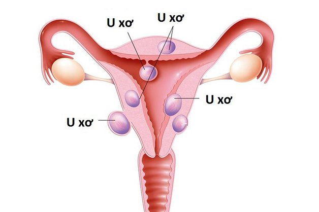 U xơ tử cung kích thước 5cm khi mang thai 10 tuần