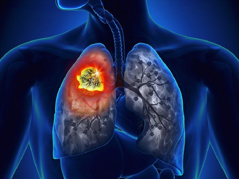 Ung thư mũi di căn phổi giai đoạn cuối