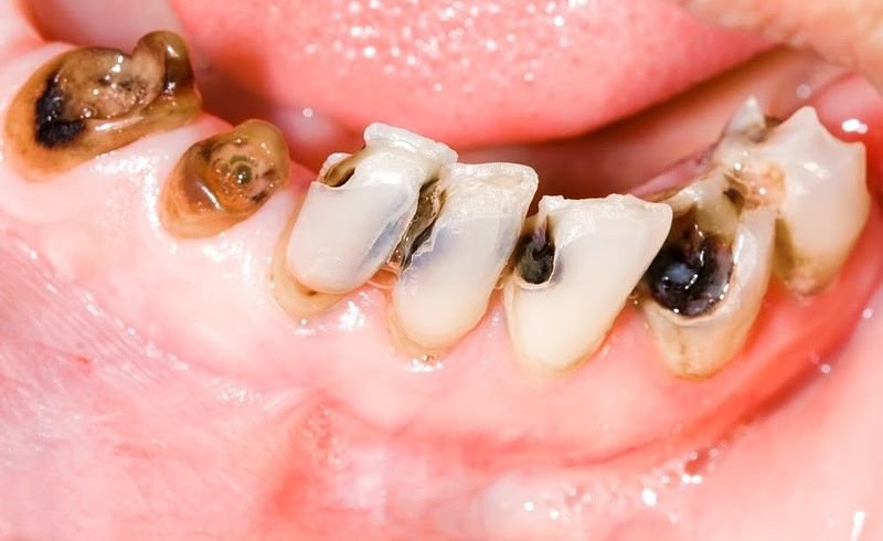 bọc răng sứ cho răng sâu