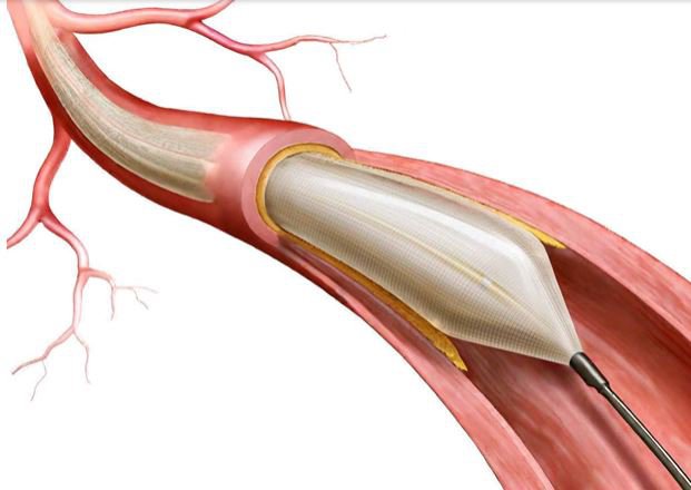 Bệnh nhân có thể được khuyến cáo điều trị bệnh mạch vành bằng thuốc hoặc phương pháp đặt stent