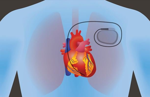 Máy tạo nhịp tim được cấy ngay dưới da ngực của bệnh nhân   Nguồn: www.pennmedicine.org