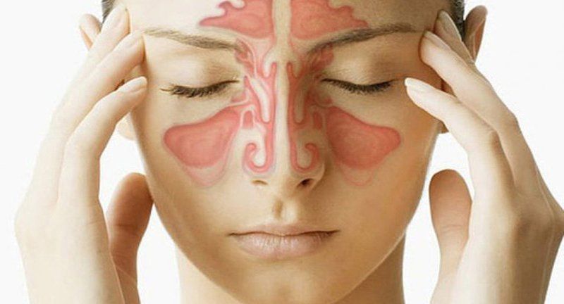 Difference Between Sinusitis And Allergic Rhinitis Vinmec