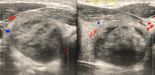 Radiofrequency Ablation Of Thyroid Nodules At Vinmec Central Park