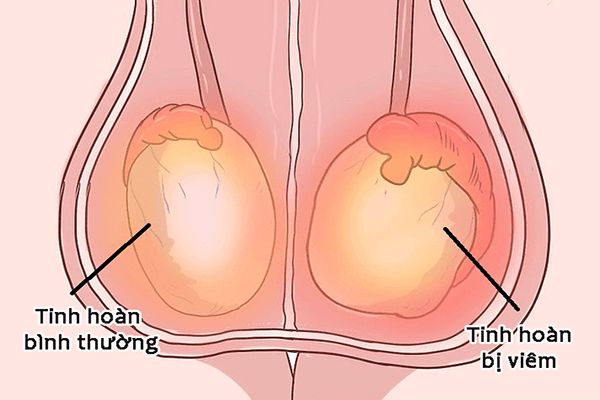 Các yếu tố nguy cơ phát triển ung thư vú ở nam giới