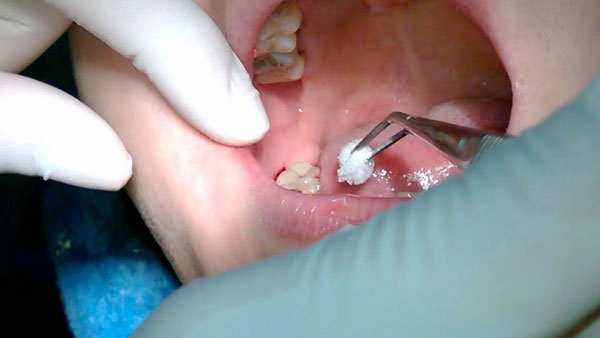Chăm sóc sau khi nhổ răng khôn