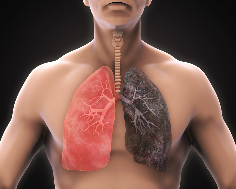 Sốt nhẹ, ho han 2 tuần là dấu hiệu của bệnh ung thư phổi đúng không?
