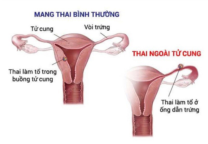 Máu Báo Thai Ngoài Tử Cung Như Thế Nào: Hiểu Rõ để Bảo Vệ Sức Khỏe Phụ Nữ