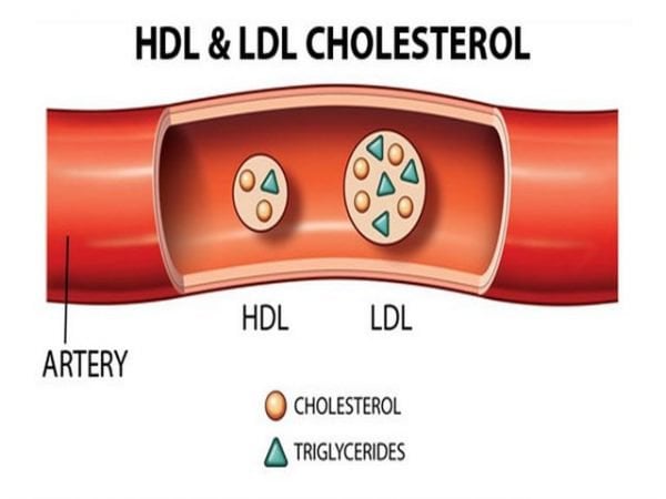 Hậu quả của mức LDL-Cholesterol cao