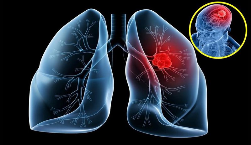 Các giai đoạn phát triển của ung thư phổi