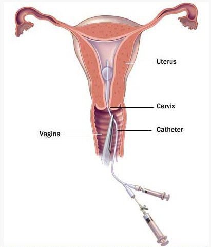Chụp X-quang buồng tử cung và vòi trứng (chụp HSG) trong trường hợp nào?
