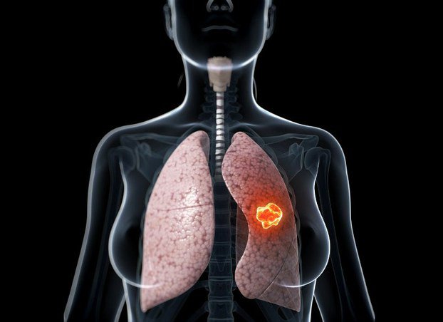 Tiên lượng điều trị ung thư phổi giai đoạn cuối