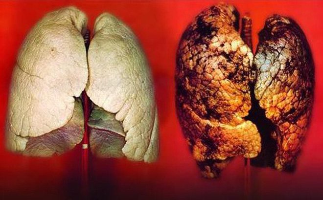 Thuốc lá gây ra nhiều bệnh ảnh hưởng tới sức khỏe con người (Ảnh minh họa)