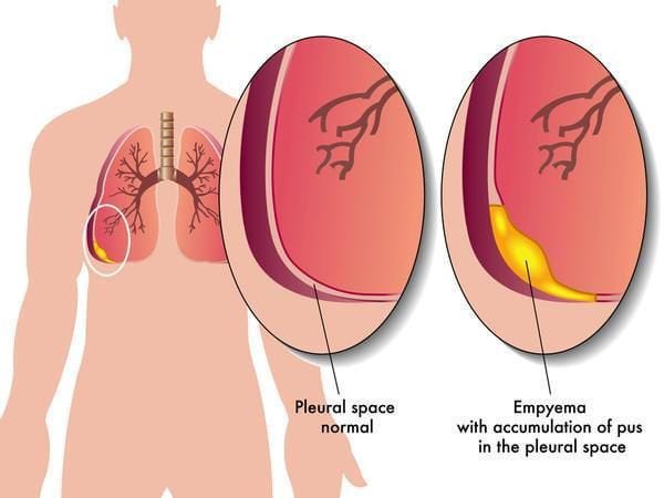 Biến chứng và hậu quả của tràn dịch màng phổi
