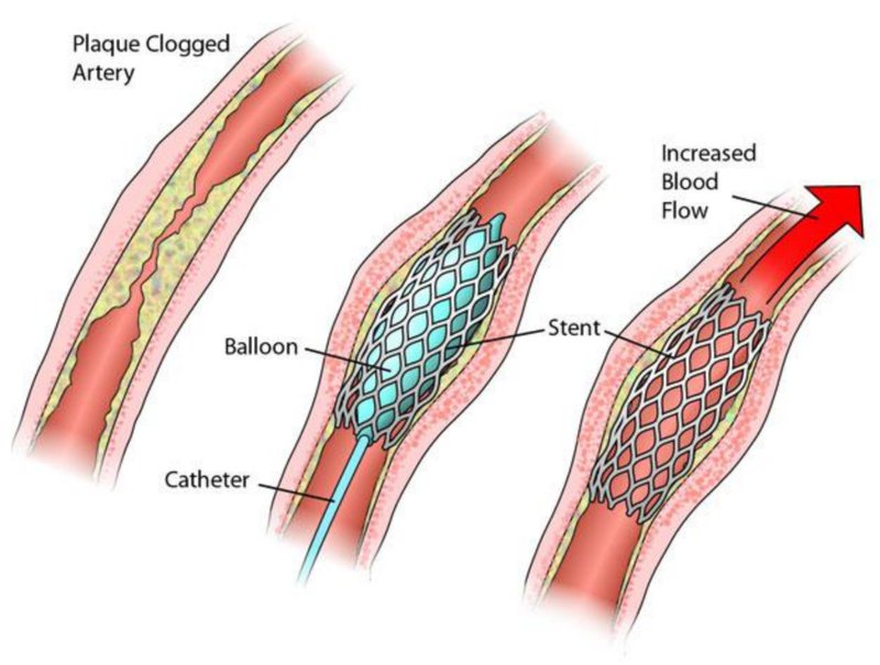 Không phải đặt stent xong là khỏi hẳn bệnh mạch vành
