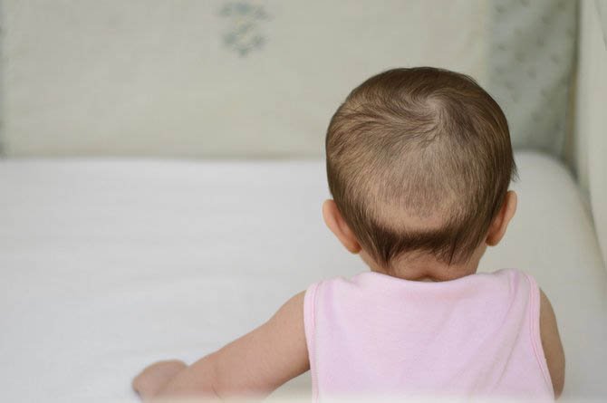 Rụng tóc vành khăn ở trẻ nhỏ có đáng lo?
