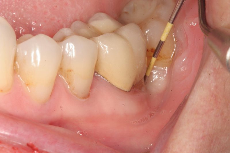 Viêm quanh cuống răng là gì?