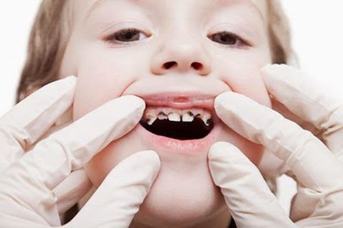Trẻ 2 tuổi bị viêm tủy răng sữa điều trị thế nào?
