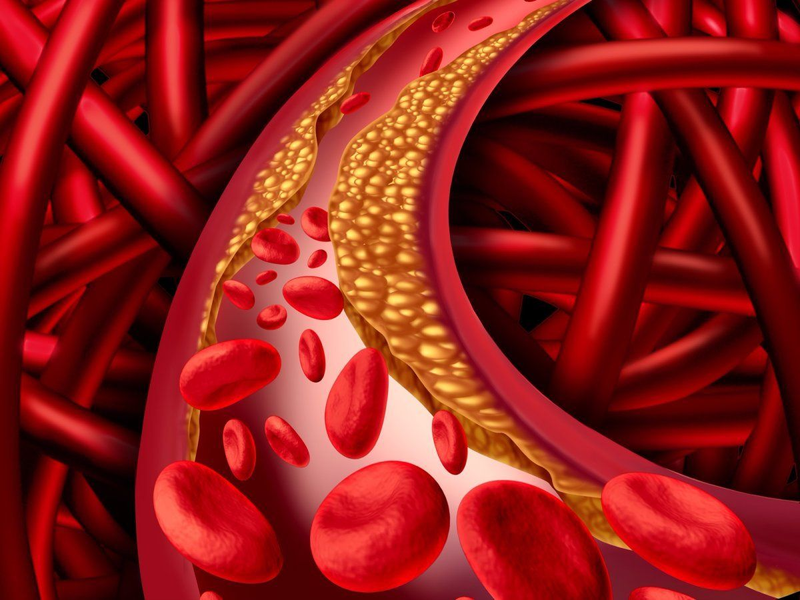 Mỡ máu cao diễn biến âm thầm, xác định bằng 4 kết quả xét nghiệm sau