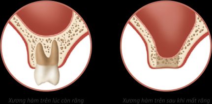 Tiêu xương răng: Những điều cần biết
