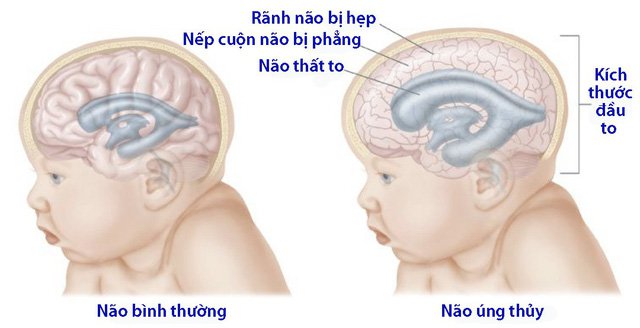 Hiện tượng úng thủy não ở trẻ sơ sinh