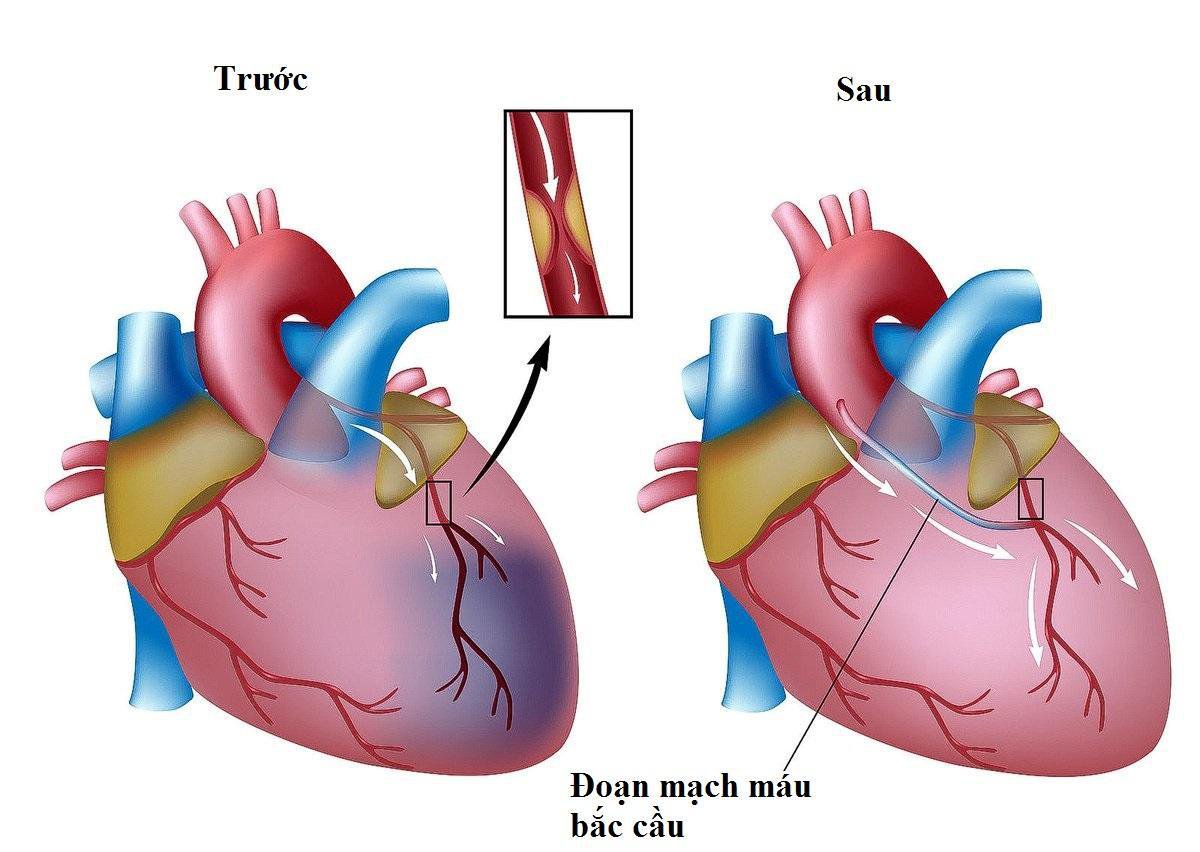 Phẫu thuật bắc cầu động mạch chủ - động mạch vành
