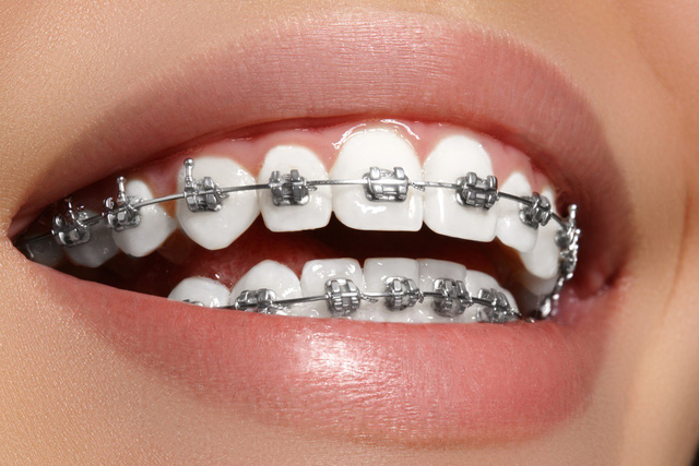 Niềng răng mắc cài kim loại phù hợp với đối tượng nào?
