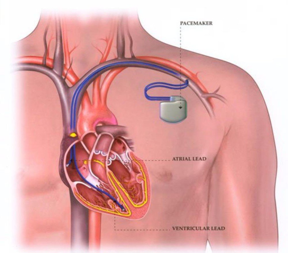 Máy tạo nhịp tim hoạt động thế nào?