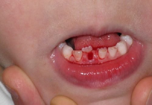Tuổi mọc răng sữa, răng vĩnh viễn và thay răng ở trẻ em