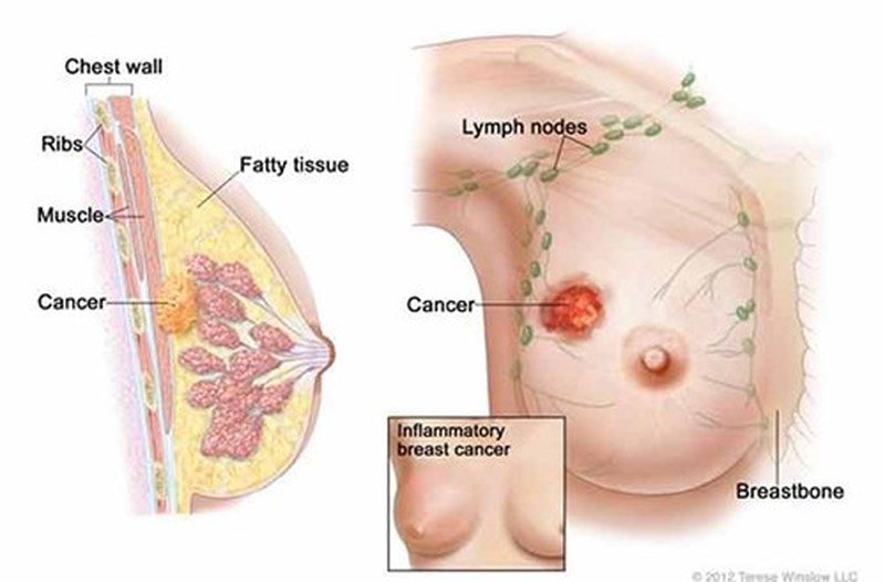 Nổi u hạch ở nách: Cảnh giác ung thư vú