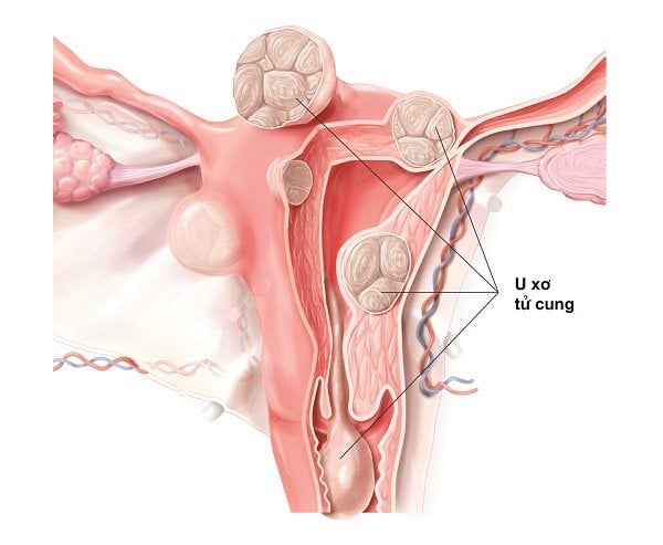 Uterine fibroids: Indications for surgery