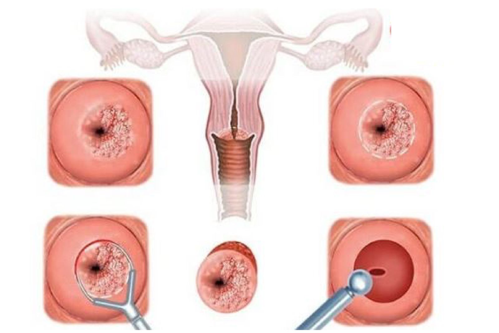 Viêm cổ tử cung: Nguyên nhân và triệu chứng cảnh báo