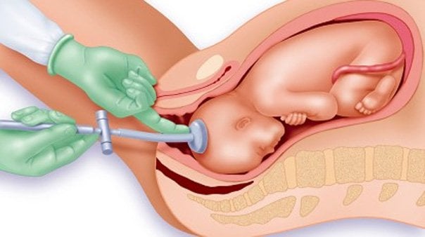 Sinh giúp bằng giác hút là thủ thuật hỗ trợ giúp sức cho bà mẹ sinh trong giai đoạn sổ thai.