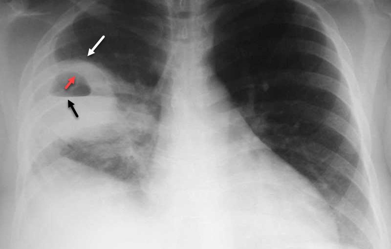 Chụp phim X-quang phổi - áp xe phổi