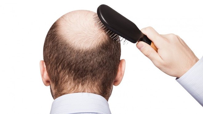 Nam hói đầu, nữ thưa tóc: Làm sao để tóc mọc lại? | Báo Pháp luật Việt Nam  điện tử