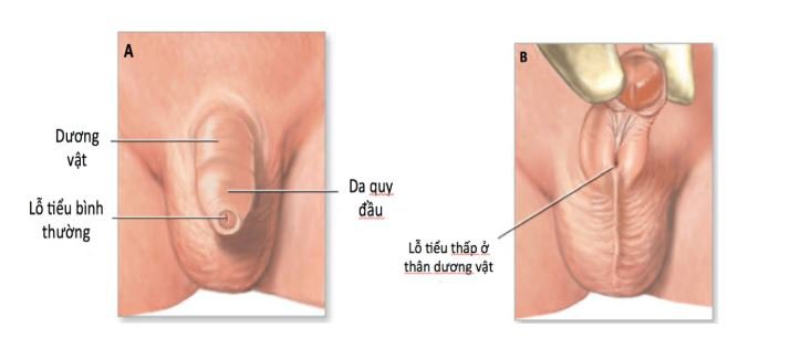 Lỗ tiểu bình thường (A), lỗ tiểu thấp (B)