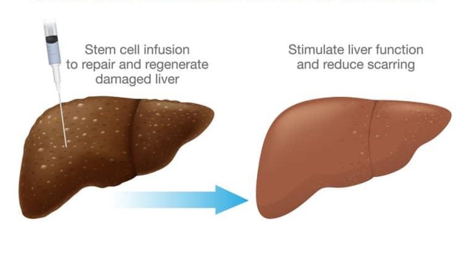 Ghép tế bào gốc cho bệnh nhân bị xơ gan