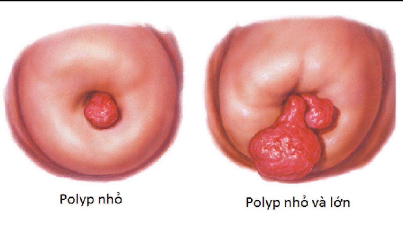 Polyp cổ tử cung là gì?