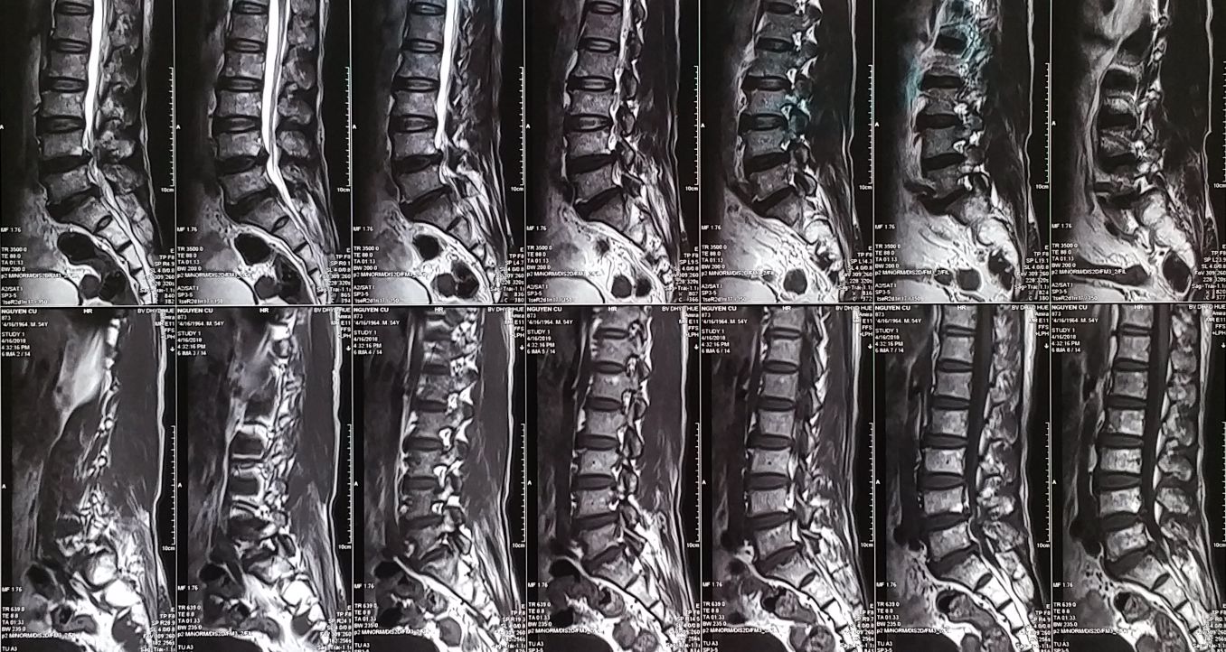 MRI cột sống thắt lưng