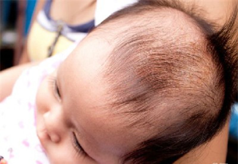 cảnh giác viêm da đầu ở trẻ