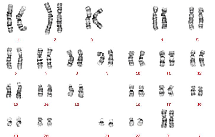 Karyotype bình thường