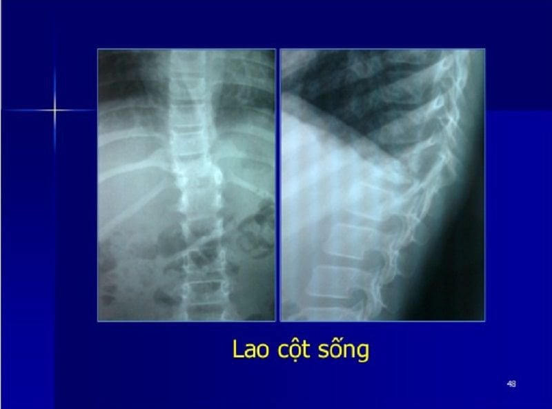 Chụp X quang bệnh lao cột sống