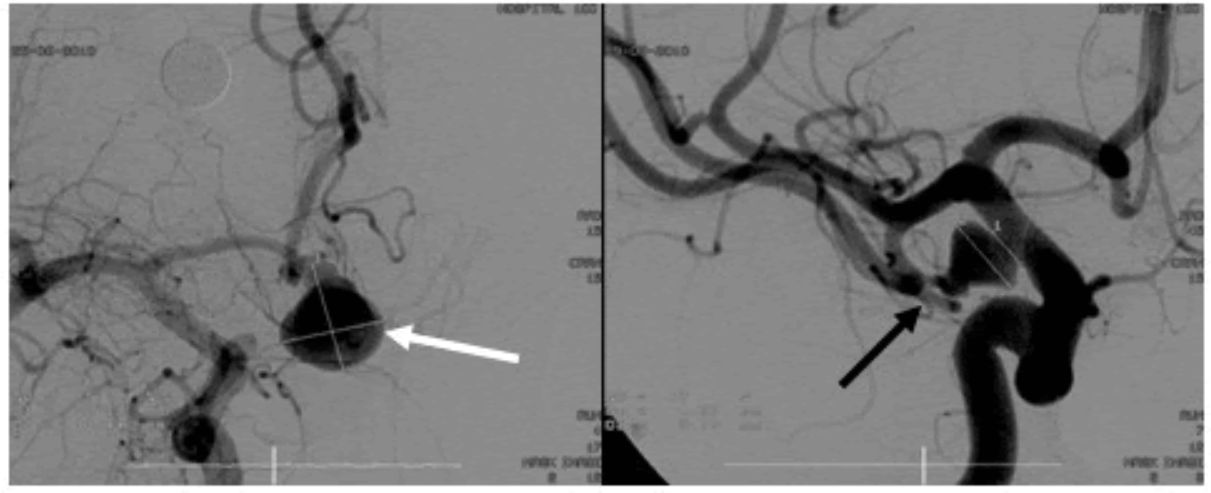 Chụp DSA động mạch não cho thấy phình mạch dạng túi (mũi tên)