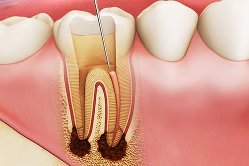 Viêm tủy răng hàm trên cần điều trị như thế nào?