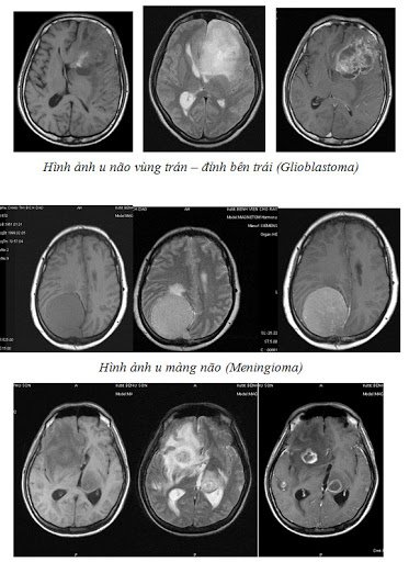 Hình ảnh chụp MRI tưới máu não