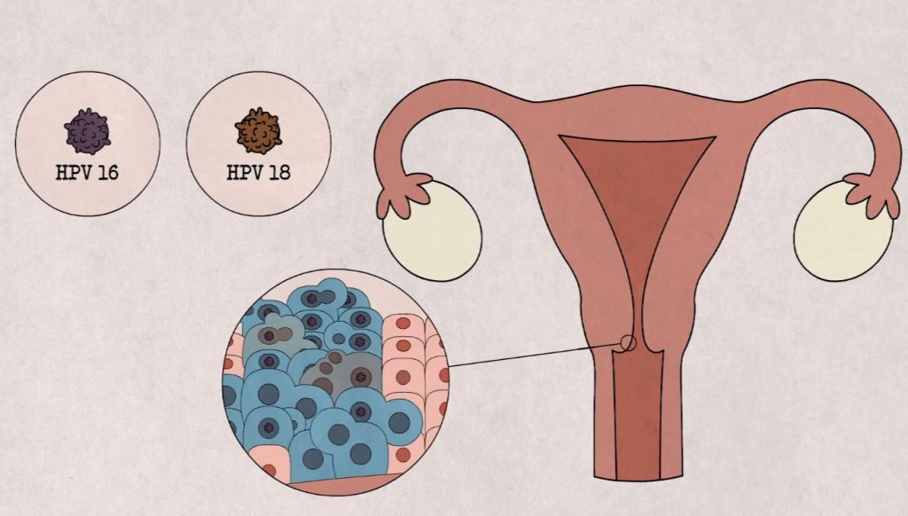 HPV ung thư cổ tử cung