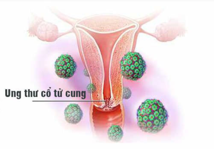 HPV và ung thư cổ tử cung